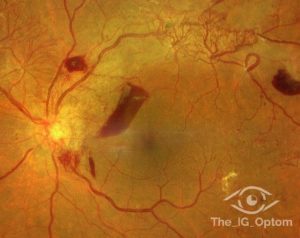 retinal detachment in type 2 diabetes